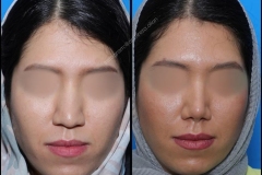 nose-surgery-0184