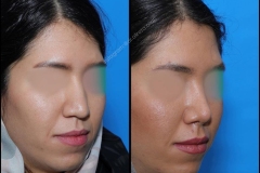 nose-surgery-0185