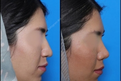 nose-surgery-0186