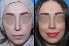 nose-surgery-0187
