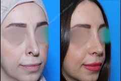 nose-surgery-0188