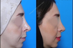 nose-surgery-0189