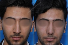 nose-surgery-0190