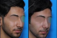 nose-surgery-0191