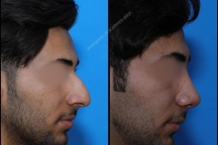 nose-surgery-0192