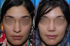 nose-surgery-0193