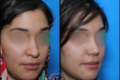 nose-surgery-0194