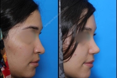 nose-surgery-0195