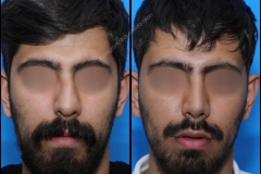 nose-surgery-0196