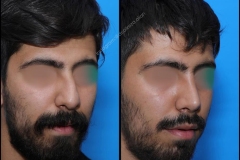 nose-surgery-0197