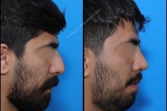 nose-surgery-0198
