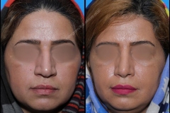 nose-surgery-0199