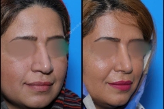 nose-surgery-0200
