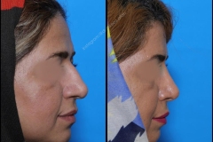 nose-surgery-0201