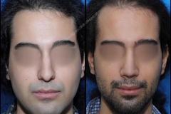 nose-surgery-0202