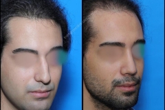 nose-surgery-0203