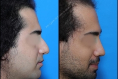 nose-surgery-0204