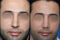 nose-surgery-0205
