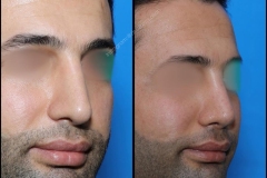 nose-surgery-0206