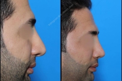 nose-surgery-0207