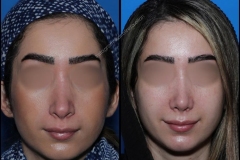 nose-surgery-0208