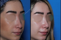 nose-surgery-0209
