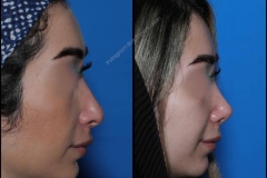 nose-surgery-0210