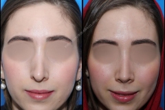 nose-surgery-0211