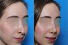 nose-surgery-0212