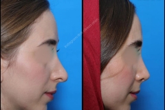 nose-surgery-0213