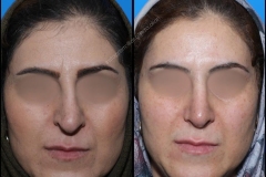 nose-surgery-0214