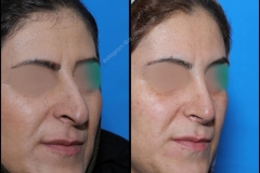 nose-surgery-0215