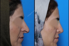 nose-surgery-0216
