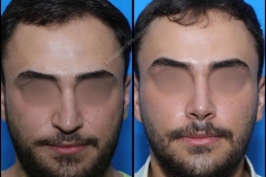 nose-surgery-0217