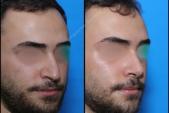 nose-surgery-0218