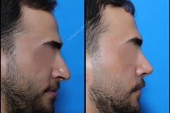 nose-surgery-0219