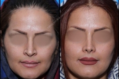 nose-surgery-0220