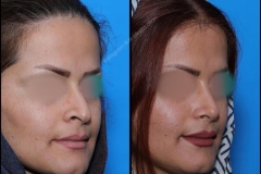 nose-surgery-0221