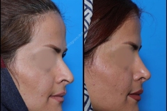 nose-surgery-0222