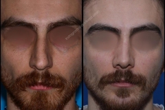nose-surgery-0223