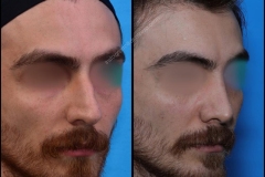 nose-surgery-0224
