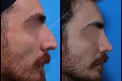 nose-surgery-0225
