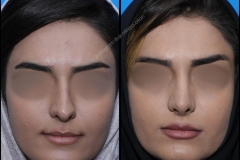 nose-surgery-0226