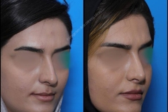 nose-surgery-0227