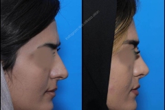 nose-surgery-0228