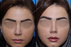 nose-surgery-0229