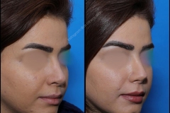 nose-surgery-0230