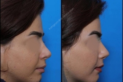 nose-surgery-0231