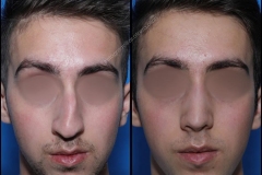 nose-surgery-0232