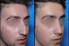 nose-surgery-0233